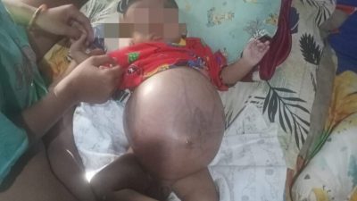 Kondisi Terkini Bayi Enam Bulan Asal Batealit Terkena Kanker