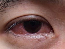 Cara Mengobati Sakit Mata dengan Daun Sirih, Panduan Lengkap dan Aman