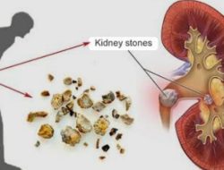 Tips Jitu Mengatasi Batu Ginjal, Hindari Operasi Sejak Dini