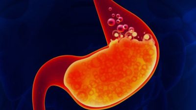 Tips dan Cara Ampuh Mengatasi Asam Lambung Secara Alami dan Medis