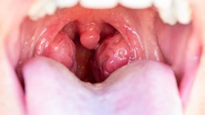 Makanan dan Minuman yang Dianjurkan Ketika Radang Tenggorokan