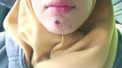 Peluru Nyasar Hantam Dagu Perawat Pajar Bulan, Insiden Terjadi di Jalan Tebat Semen Muara Enim