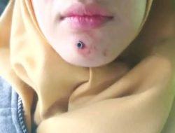 Peluru Nyasar Hantam Dagu Perawat Pajar Bulan, Insiden Terjadi di Jalan Tebat Semen Muara Enim